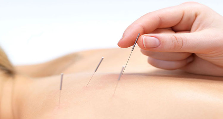 acupuncture