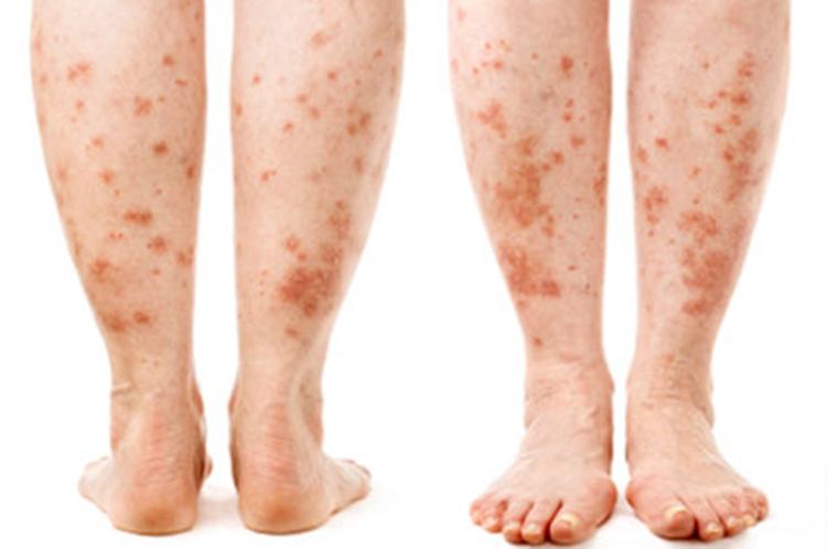 What Causes Leg Rash In Diabetes 