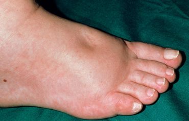 diabetes swollen feet