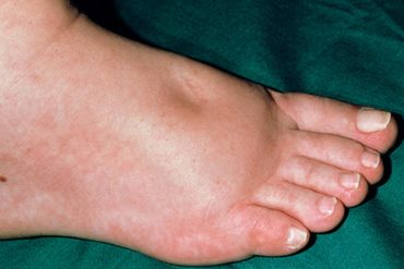 diabetes swollen feet