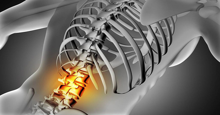 10 Signs and Symptoms of Spinal Stenosis