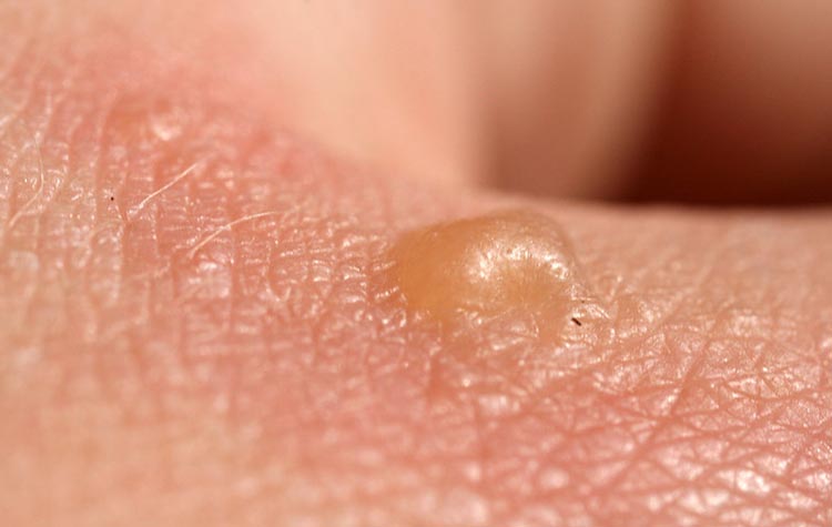 What Causes Red Blood Blisters On The Skin