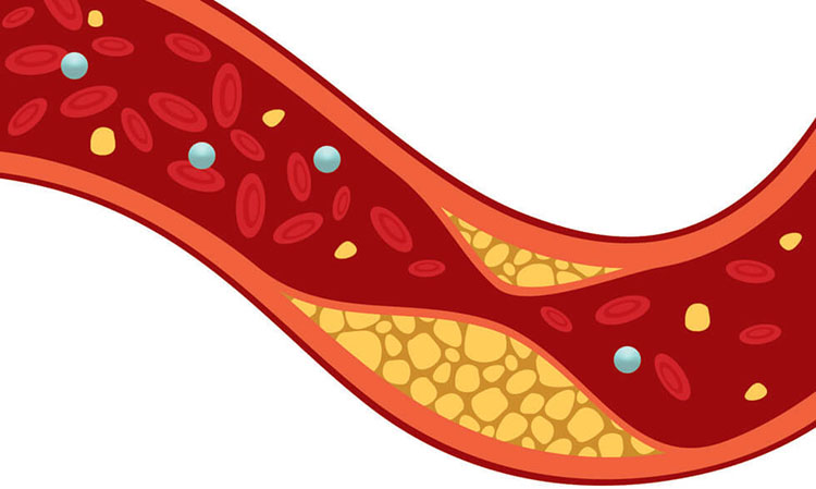 hyperlipidemia symptoms