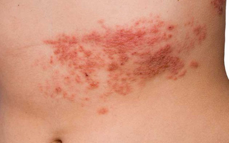 symptoms of shingles