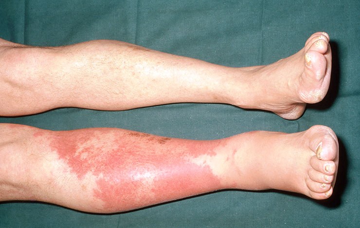 Cellulitis and Diabetes