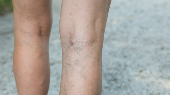 10 Signs and Symptoms of Blood Clot In Leg