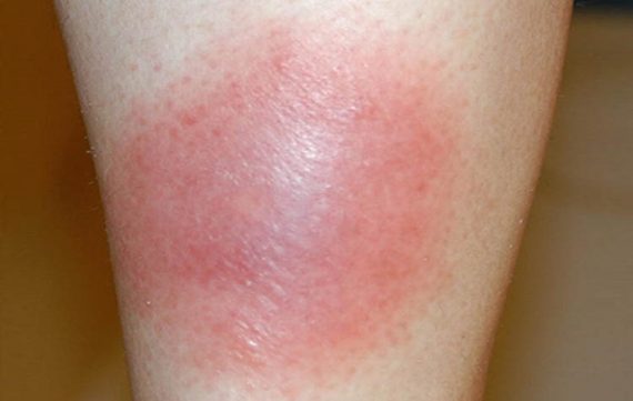 10 Signs and Symptoms of MRSA