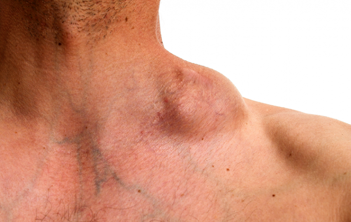 lymphoma swollen neck and supraclavicular lymph nodes