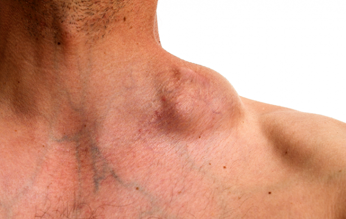 enlarged lymph node in back of neck