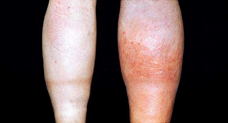 symptoms of a blood clot in the leg