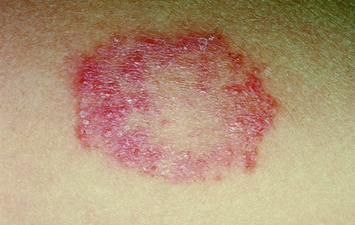 10 Signs and Symptoms of Ringworm