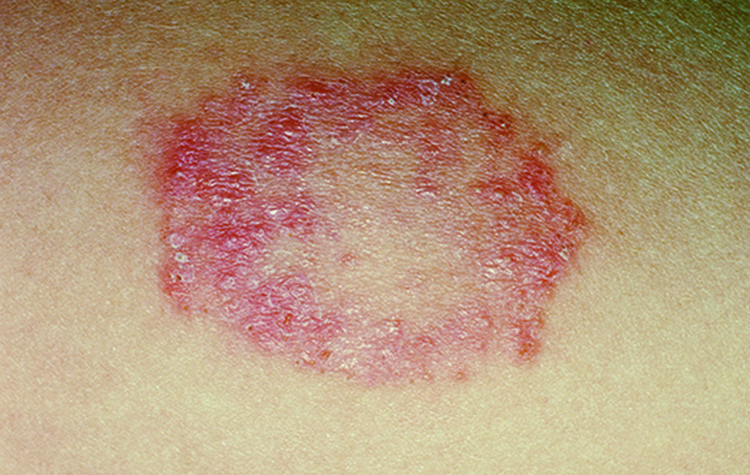 10 Signs and Symptoms of Ringworm