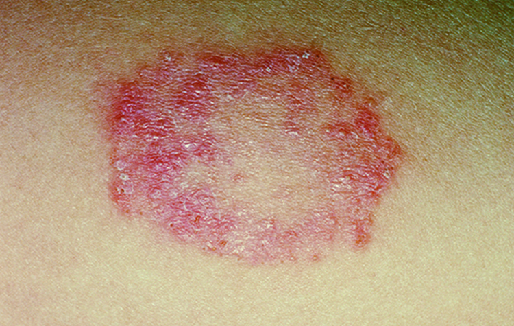 10 Signs And Symptoms Of Ringworm