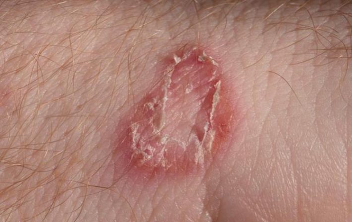 10 Signs And Symptoms Of Ringworm