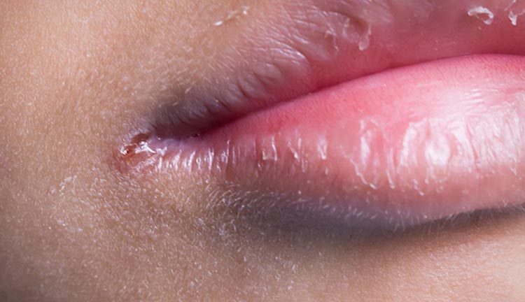 10 Signs and Symptoms of Oral Thrush