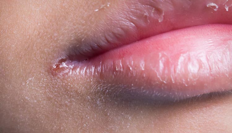 10 Signs And Symptoms Of Oral Thrush 