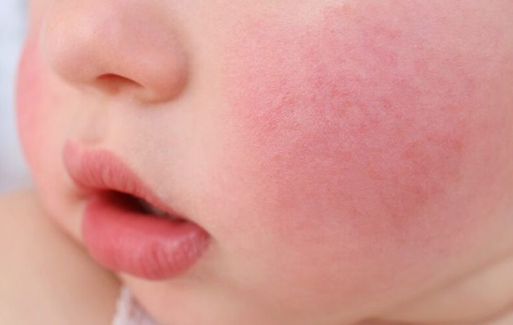 10 Signs and Symptoms of Fifth Disease