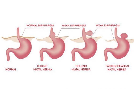 10 Signs and Symptoms of Hernia You Need to Know