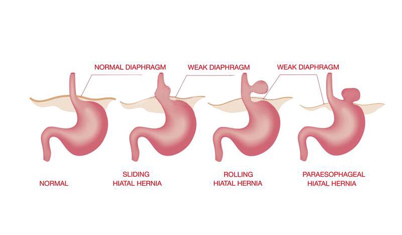 10 Signs And Symptoms Of Hiatal Hernia